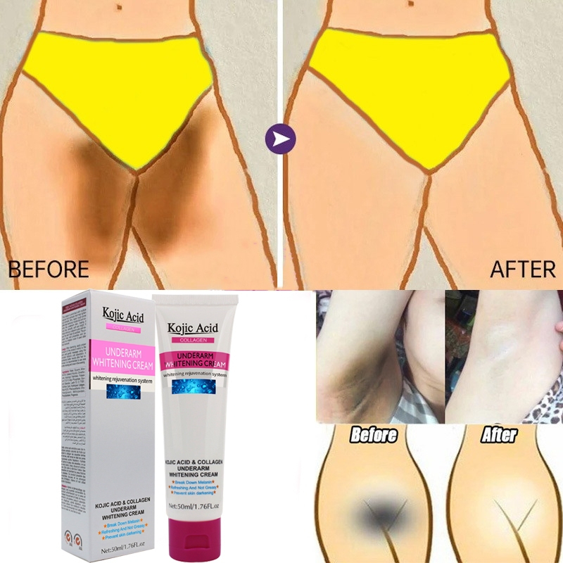 Kojic Acid ครีมขาหนีบดำ 50ml ครีมทารักแร้ขาว ครีมบำรุงรักแร้ เข่าดำ ผิวขาว สิ่งประดิษฐ์ ครีมขาหนีบดำ