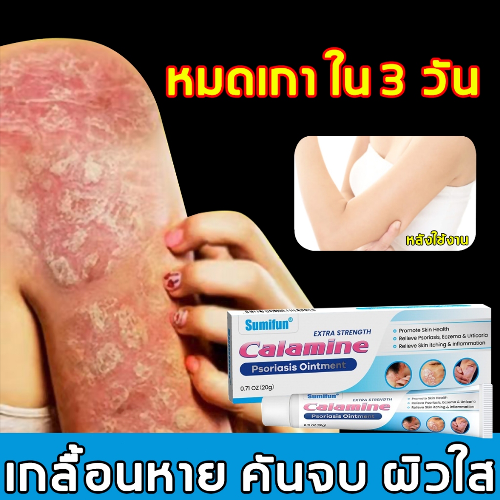 ครีมลดอาการคัน 20g ทาแก้คัน ผิวหนังทากากเกลื้อน สารสกัดจากพืชใช้ได้ทั้งตัวบอกลาผิวคันได้ง่ายๆ Psoriasis cream