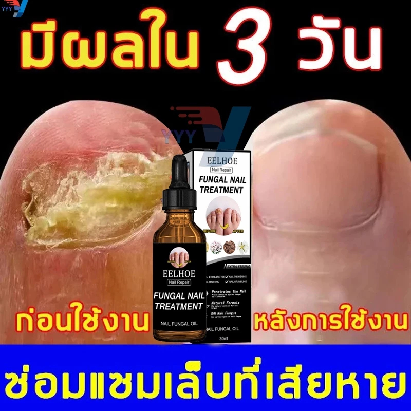 เซรั่มบำรุงเล็บ EELHOE รักษาเชื้อราเล็บ รักษาเล็บขบ ฆ่าเชื้อราที่เล็บ น้ำยาบำรุงเล็บ เชื้อราที่เล็บ