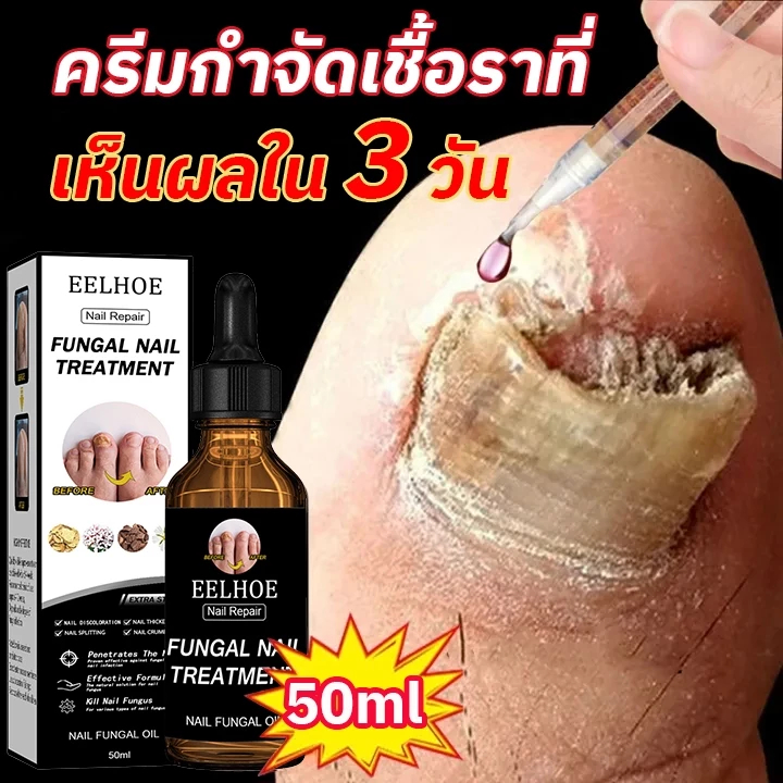nail repair serumเล็บ ขบ รักษา รักษารคเชื้อราที่เล็บ เอสเซ้นส์ดูแลเล็บ ซ่อมเล็บฉีก เล็บซ่อมของเหลว กันเชื้อรา บํารุงเล็บ