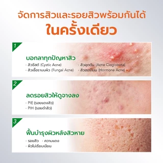 YOU AcnePlus Spot Clear Pro Serum 15g. บาล์มแต้มสิวใบบัวบก จบปัญหาผิวเป็นสิว สิวอักเสบ สิวอุดตัน สูตรอัพเกรด