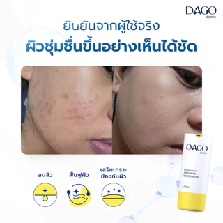 [Set 2 ชิ้น] มอยเจอร์ไรเซอร์ คุมมัน Dagoderma ลดรอยสิว ชุ่มชื้นยาวนาน Penta-Peptide Anti Acne Moisturizer 30ml.