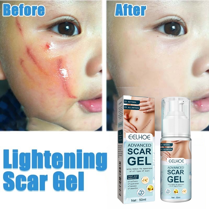 รอยแผลเป็น ครีมแผลเป็น 50g ทาแผลคีลอยด์ ลดแผลเป็น ครีมทาแผลผ่าคลอด ลดแผลไฟไหม้ รอยสิว แผลผ่าตัดเป็นต้น Scar cream