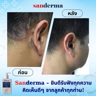 SANDERMA แชมพูรักษา ‘เชื้อรา โรคสะเก็ดเงิน ลดอาการคัน ขจัดรังแค ปัญหาน้ามรัง’