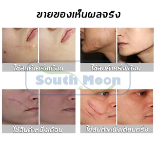 【จัดส่งจากกรุงเทพฯ】South Moon รักษารอยแผลเป็น แผ่นแปะแผลเป็น 4cm*150cm กําจัดรอยแผลเป็นจากแผลเป็น เผยผิวเนียนสวย