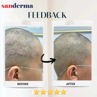 [ซื้อ 1 แถม 1] แชมพูบำรุงหนังศีรษะ SANDERMA ของแท้ ทำความสะอาดรังแคและปรับสมดุล (300 กรัม) สำหรับหนังศีรษะแพ้ง่ายและผมอ