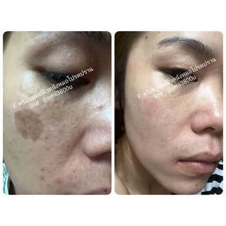 ครีมฝ้ากระหมอโปรดปราน