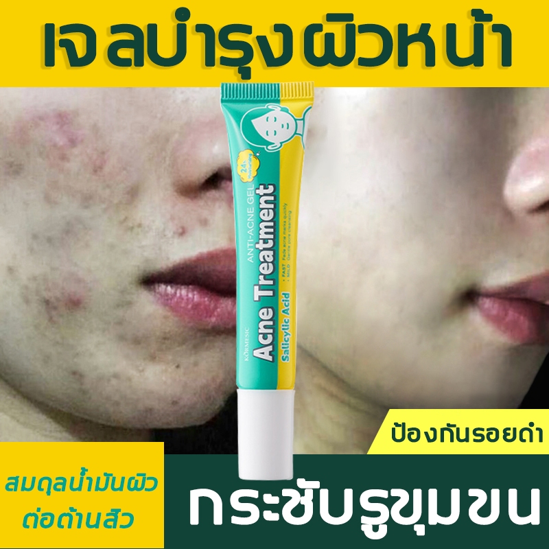 ของแท้ เจลรักษาสิว เจลแต้มสิวฉุกเฉิน แอนติเบลมมิชเจล เนื้อเจลสูตรเข้มข้น ช่วยลดปัญหาสิว ช่วยให้ผิวดูเรียบเนียน