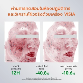 YOU AcnePlus Spot Clear Pro Serum 15g. บาล์มแต้มสิวใบบัวบก จบปัญหาผิวเป็นสิว สิวอักเสบ สิวอุดตัน สูตรอัพเกรด