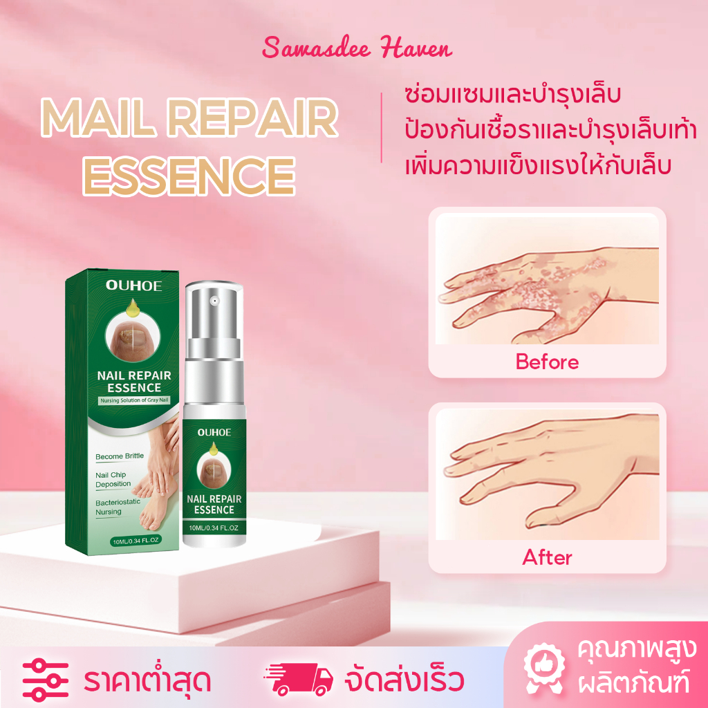 OUHOE สเปรย์บำรุงเล็บ สเปรย์บำรุงเล็บเท้า สเปรย์ป้องกันเชื้อราเล็บ ป้องกันเชื้อรา บำรุงเล็บเท้า ป้องกันการเกิดเล็บขบ