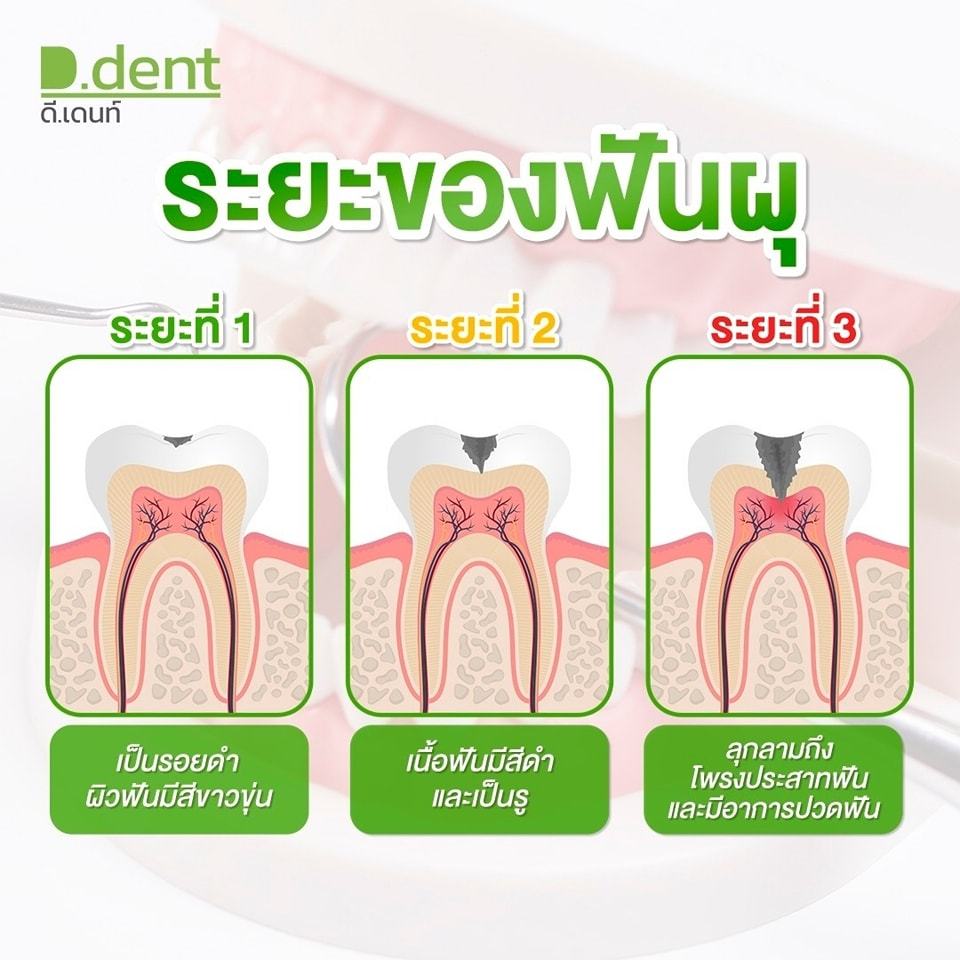 ยาสีฟันดีเดนท์ 10 หลอด D.Dent  ยาสีฟันสมุนไพร ยาสีฟันดีเด้น ขนาด 100ml. - ภาพย่อย 3