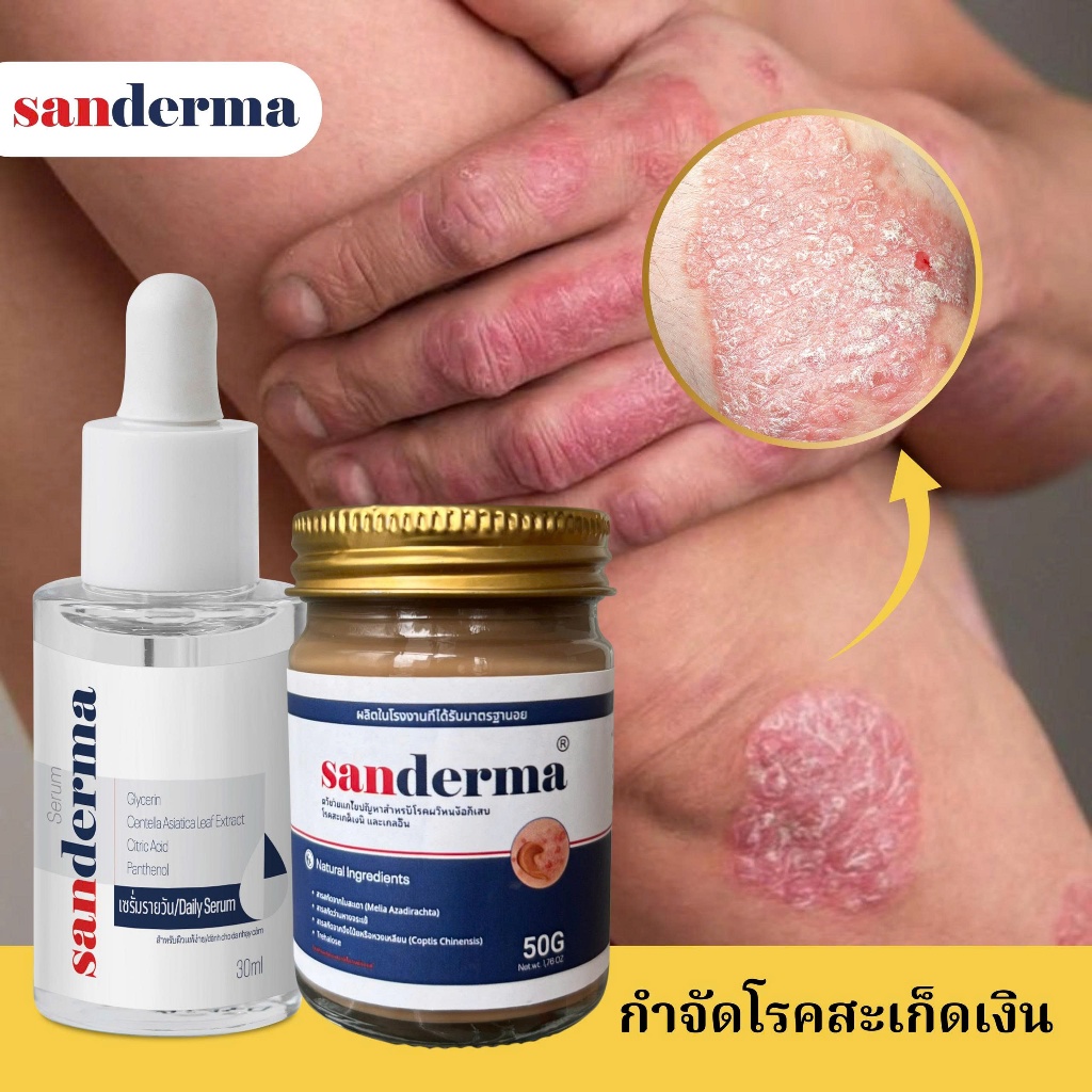 [COMBO SANDERMA CREAM & SERUM] ครีมบำรุงผิว โรคสะเก็ดเงิน คัน แพ้เหงื่อ กลากเกลื้อน