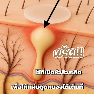 (มีส่งด่วน)แผ่นแปะดูดสิวลายดาวใส ไฮโดรคอลลอยด์แท้