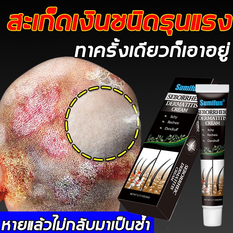 ครีมลดอาการคัน 20g ทาแก้คัน ผิวหนังทากากเกลื้อน สารสกัดจากพืชใช้ได้ กลากเกลื้อน สะเก็ดเงิน สิวที่หลัง เชื้อรา ราคา ถูกที่สุด ดีลบีเคเค แกลเลอรีภาพที่ 2