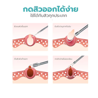 Simple Healthcare ชุดกดสิว 7 ชิ้น ที่กดสิว ทำจากสแตนเลส พกพาสะดวก
