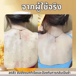 LYDIMOON เจลอาบน้ำแอนตี้แบคทีเรีย สบู่อาบน้ํา เจลอาบน้ำแก้คัน 500ml กำมะถันครีมอาบน้ำ ลดรอยดำ ผดผื่น สิวหลัง หน้าอก หลัง