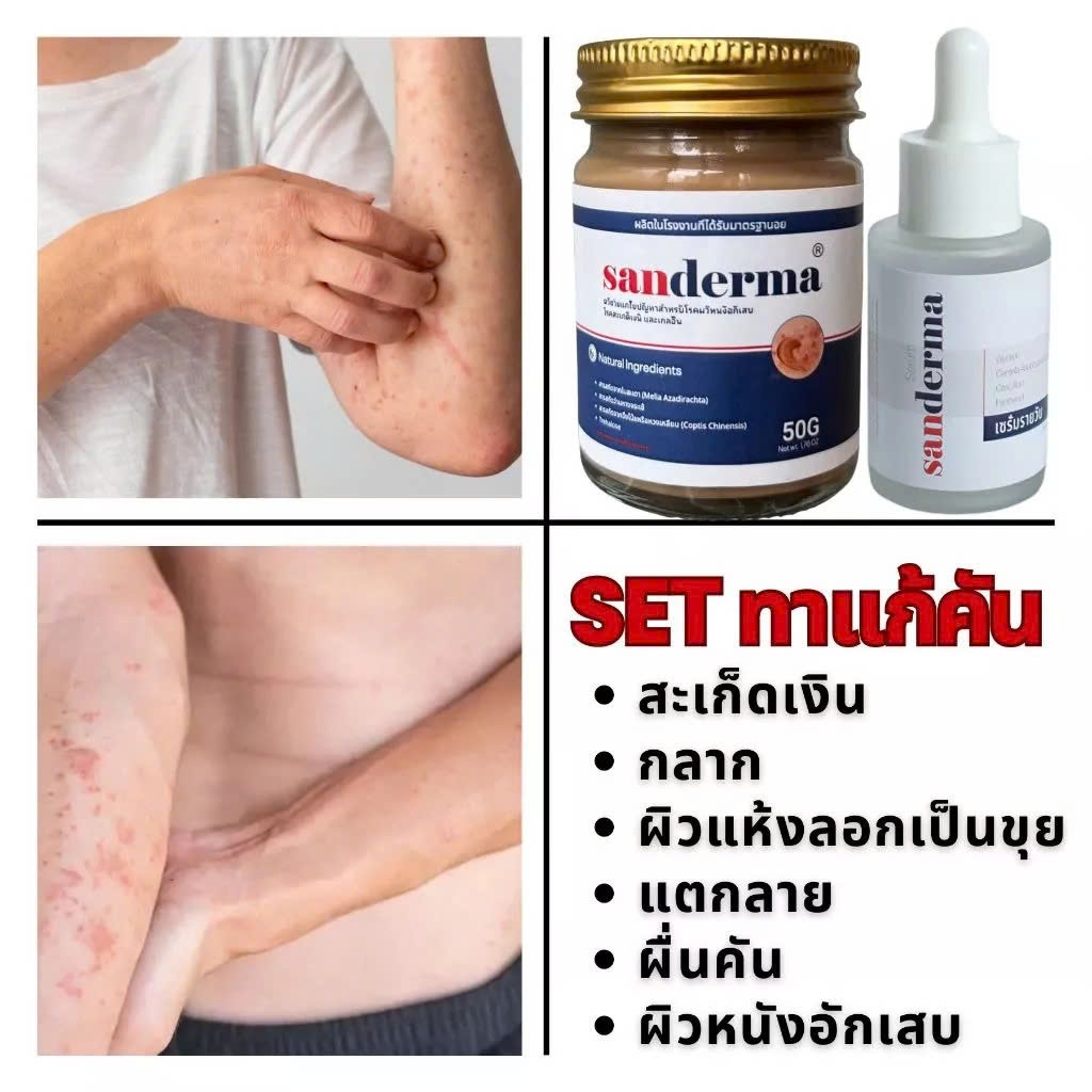 COMBO CREAM & SERUM SANDERMA เชี่ยวชาญเฉพาะด้าน โรคผิวหนังทุกชนิด โรคสะเก็ดเงิน คัน แพ้เหงื่อ กลากเก
