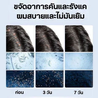 【1 แถม 1】แชมพูรังแค แชมพูคัน แชมพูยาเชื้อรา 500ml แชมพูแก้คันหนังศรีษะ ขจัดรังแค หยุดอาการคัน ลดผมร่วง ยาสระผมขจัด