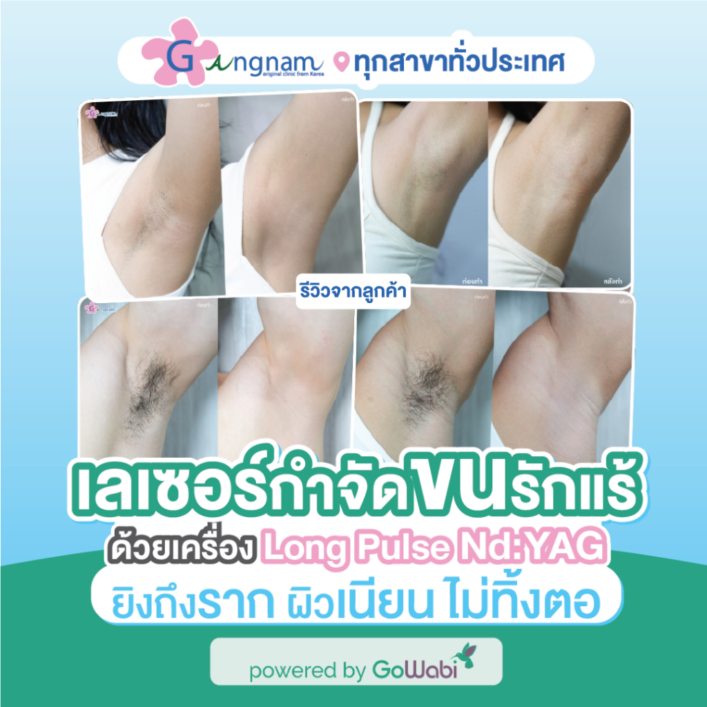 [E-voucher] Gangnam Clinic - เลเซอร์กำจัดขนด้วย Long Pulse Nd:YAG บริเวณรักแร้ (1 ครั้ง)