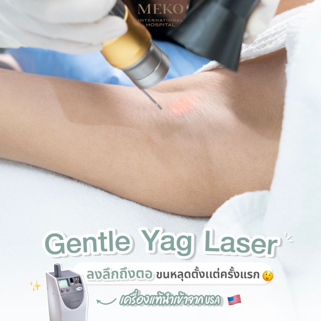 เลเซอร์กำจัดขนรักแร้ถาวร ด้วยเครื่อง Gental Yag