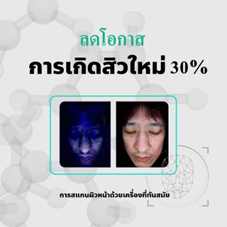 B1 ครีมสิวสูตร เมก้า ด็อกเตอร์แนน สิวอุดตัน สิวฝังลึก กดไม่ออก สิวผด สิวอักเสบ ผิวแพ้ง่ายก็ใช้ดี