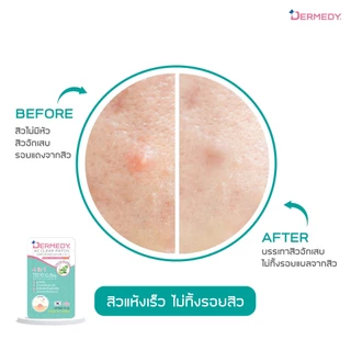DERMEDY AC CLEAR PATCH 4 IN 1 เดอร์มีดี เอซี เคลียร์ แพทช์ (6 ดวง)