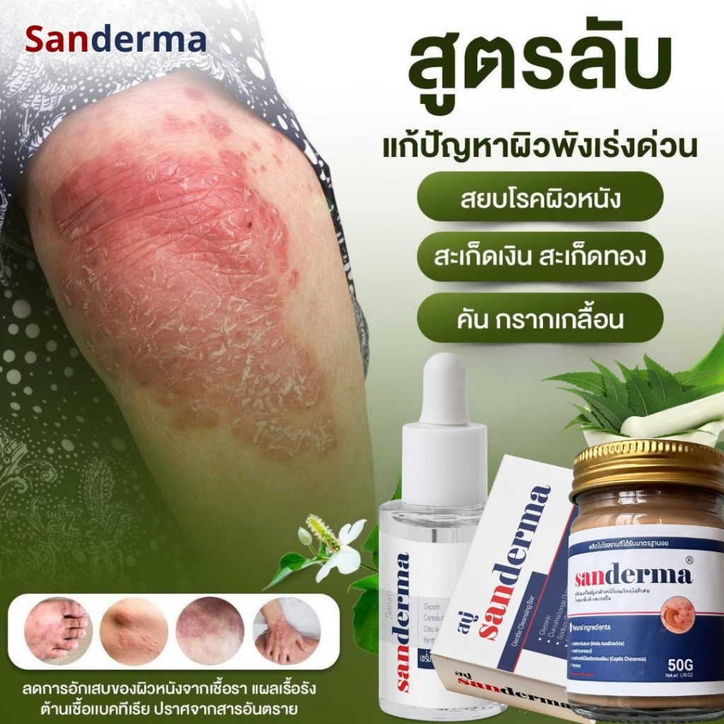 SANDERMA COMBO CREAM และ SERUM - ลดผื่น คัน กลากเกลื้อน สะเก็ดเงิน ผิวแพ้ง่าย
