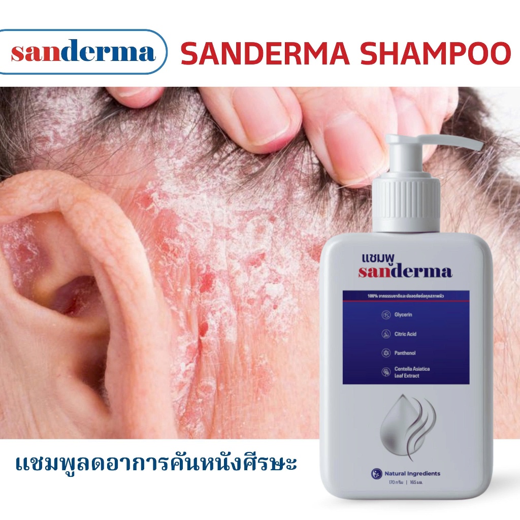 SANDERMA แชมพูรักษา ‘เชื้อรา โรคสะเก็ดเงิน ลดอาการคัน ขจัดรังแค ปัญหาน้ามรัง’