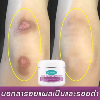 รอยแผลเปน ลอยแผลเป็น ครีมรอยแผลเป็น ฮีรูดอย แผลเป็น ครีมลดรอ…