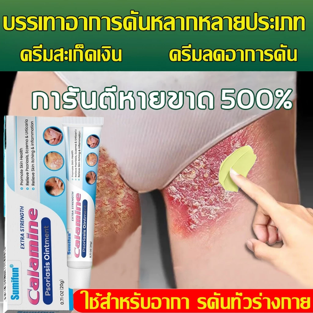 ครีมแก้คัน ครีมลดอาการคัน สะเก็ดเงินครีม โรคผิวหนัง เกลื้อน กลาก คัน สมุนไพร แก้คันเรื้อรัง คันในร่มผ้า