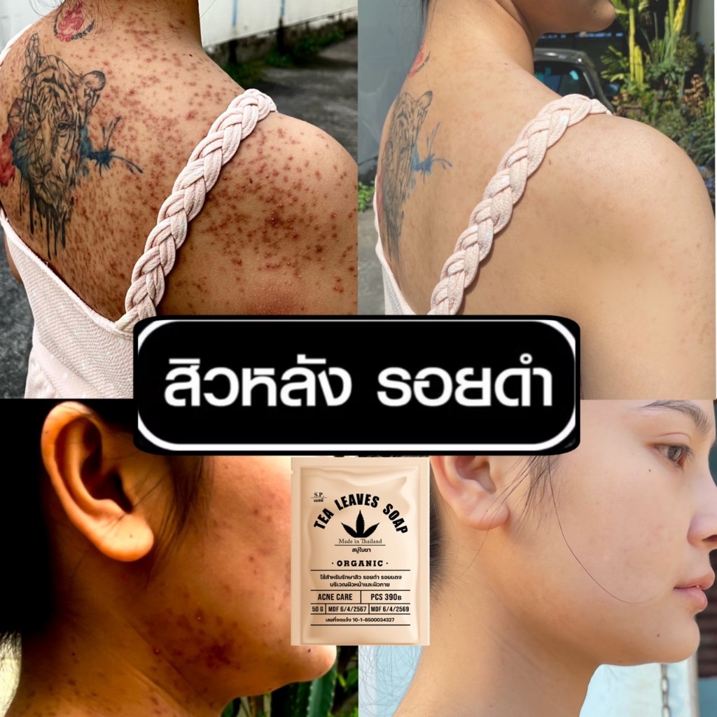 สบู่ใบชารักษาสิวหลัง ใบหน้า หน้าอก สูตรแพทย์แผนไทย สบู่รักษาสิวผด สบู่รักษารอยดำสบู่รักษารอยแดงสบุ่รักษาสิวที่หน้า
