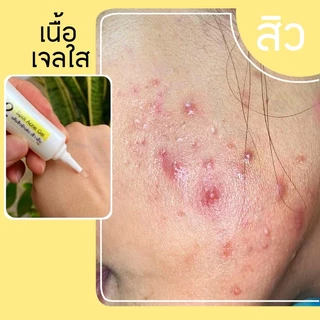 เจลแต้มสิว หลอดฝาเหลืองสูตรเมก้าด็อกเตอร์แนน