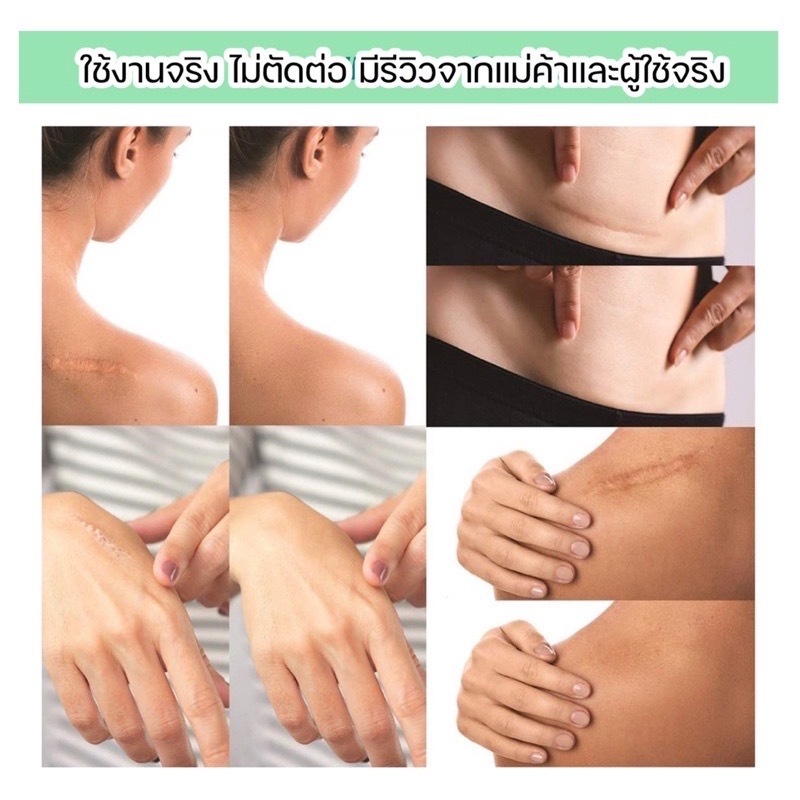 South Moon รักษารอยแผลเป็น แผ่นแปะแผลเป็น 4cm*150cm กําจัดรอยแผลเป็นจากแผลเป็น เผยผิวเนียนสวย - รูปที่ 5