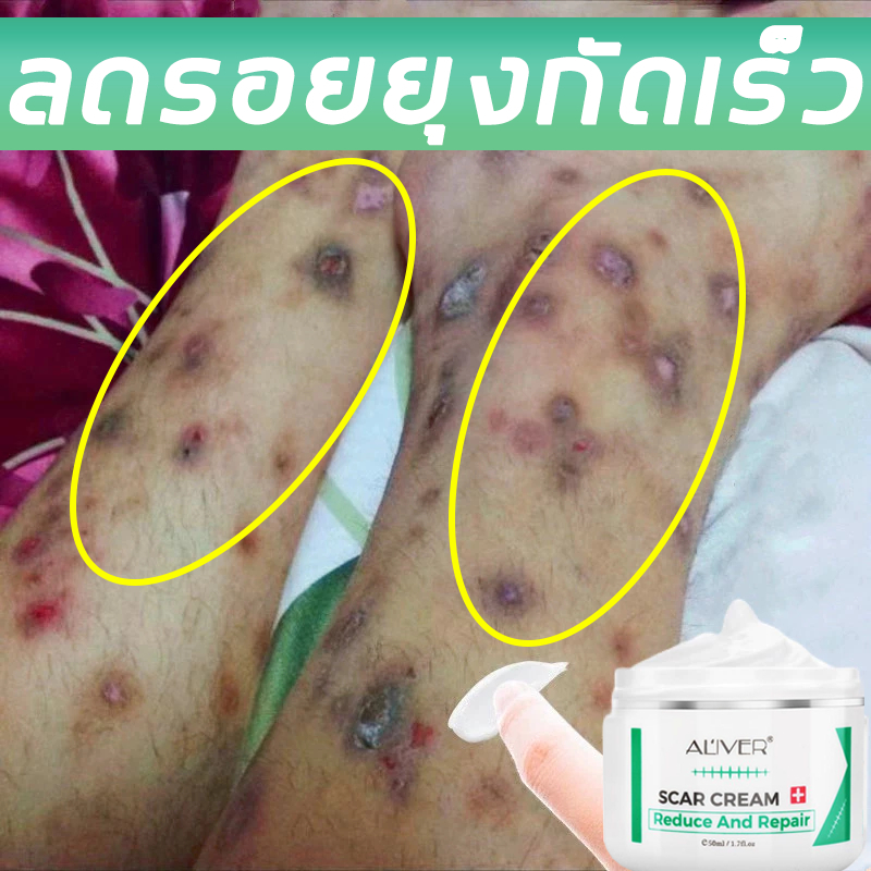 【มีสินค้าพร้อมจัดส่ง】ALIVER 50ml ครีมลดรอยแผลเป็น แผลเป็น ลดเลือนแผลผ่าตัดการคลอด แผลผ่าตัด แผลเป็นใหม่และแผลเป็นเก่า