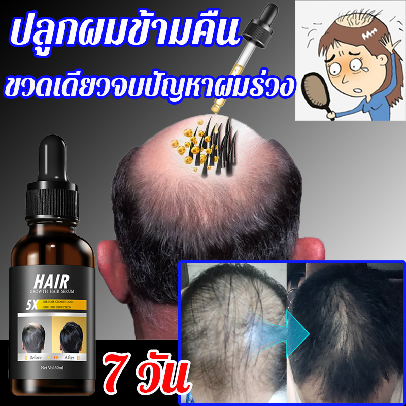 บอกลาความกังวลเรื่องศีรษะล้าน เซรั่มปลูกผม ป้องกันผมร่วง เร่งผมยาว ฟื้นฟูผม น้ำยาเร่งผมยาว น้ำยาปลูกผม ทรีทเม้นต์ปลูกผม