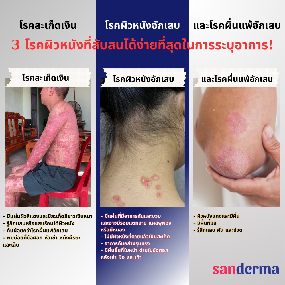 COMBO ทาแก้คัน SANDERMA CREAM และ SERUM SANDERMA - รูปที่ 5
