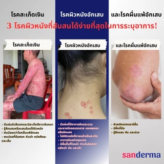[Combo 2] Sanderma ครีมแก้คัน และ เซรั่ม แซนเดอร์ม่า ลดผื่นคัน เชื้อรา ผิวแพ้ง่าย ลดรอยแดง