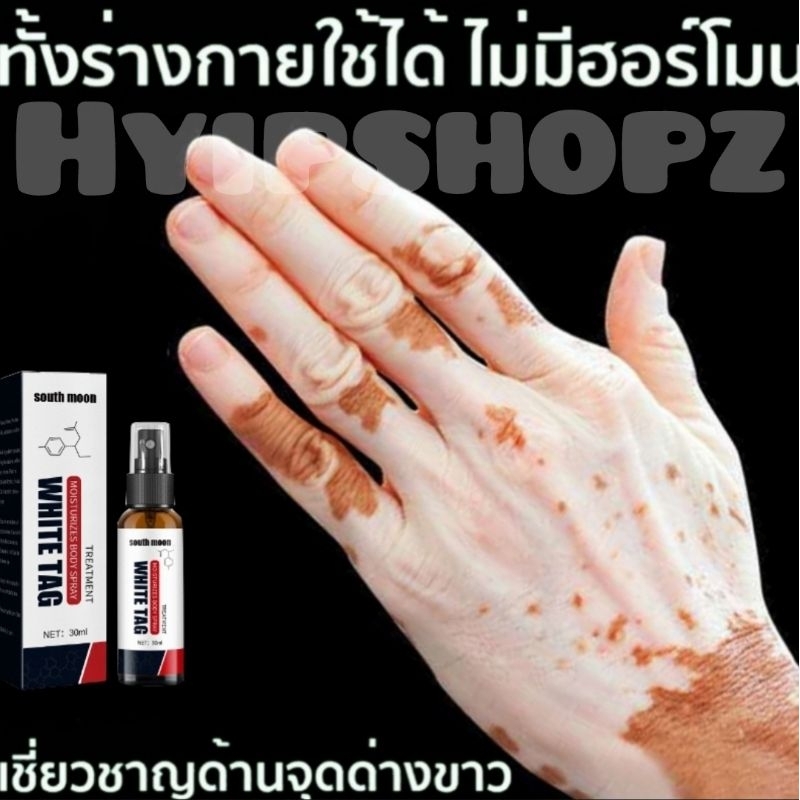แถมฟรี!ครีมทาด่างขาว สเปรย์ด่างขาว ด่างขาวที่หน้า ด่างขาวตามร่างกาย ซ่อมแซมดูแล ปรับเม็ดสีของผิวได้อย่างมีประสิทธิภาพ