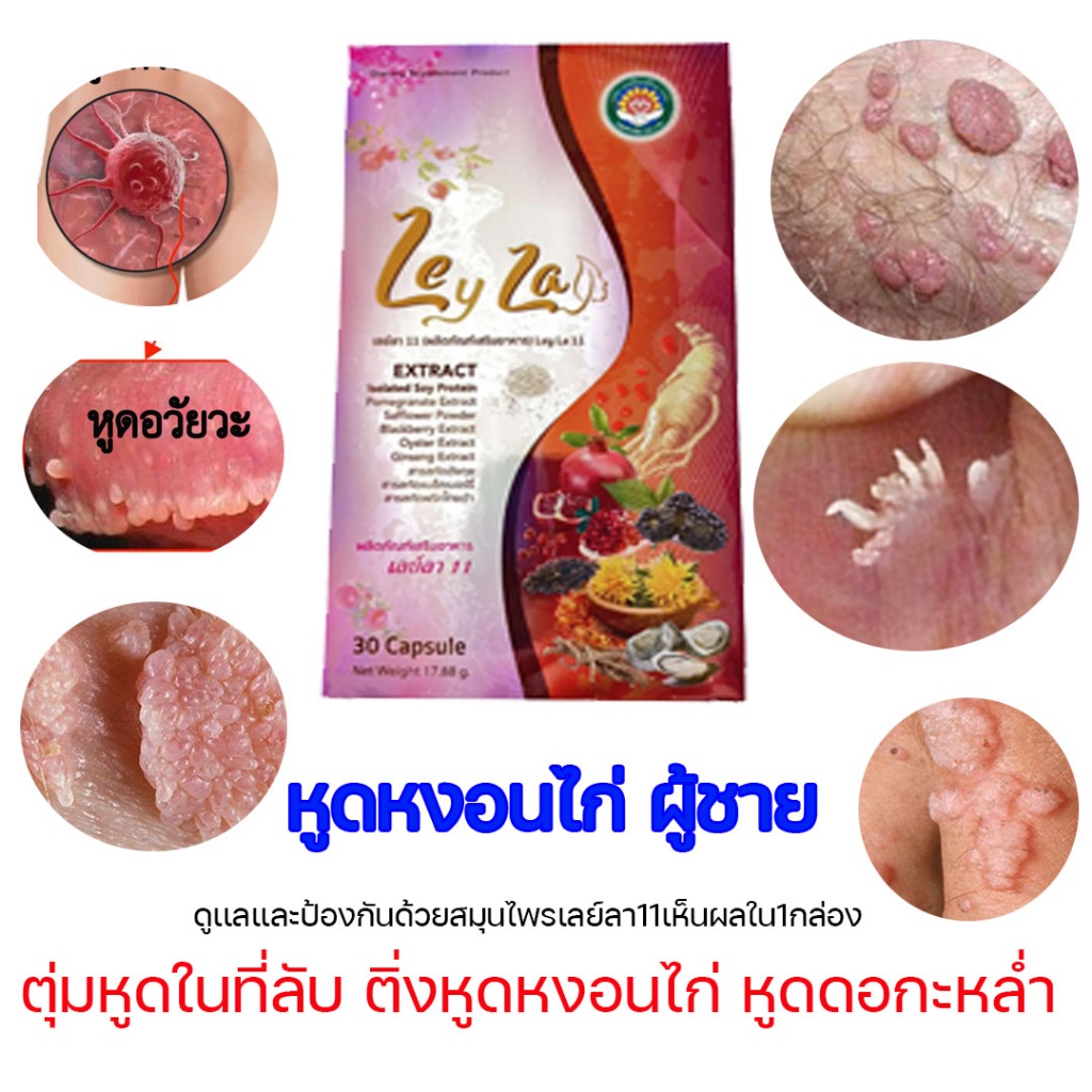 เสริมอาหารหูดหงอนไก่ สมุนไพรรักษาติ่งหูดหงอนไก่ หูดหงอนไก่