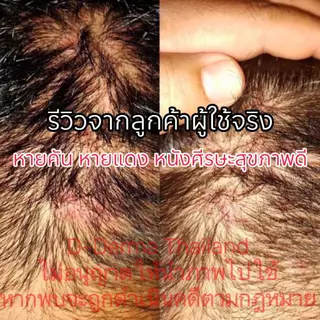 (เจ้าของ!!) เซ็ทแชมพูและเซรั่มดูแลศีรษะ รังแค ศีรษะลอก เซ็บเดิร์ม ต่อมไขมันอักเสบ สิวที่หัว ชันนะตุ