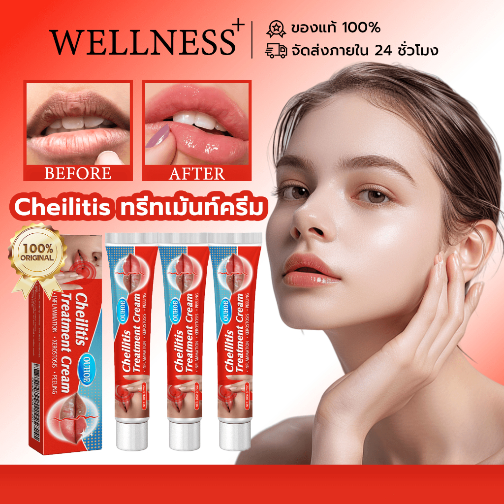 Ouhoe Cheilitis ทรีทเม้นท์ครีม ครีมบำรุงริมฝีปาก Labial Herpes ครีมต้านเชื้อแบคทีเรีย ซ่อมแซมริมฝีปาก ริมฝีปากดำ