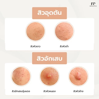 Medileen Acno ลดสิว คุมมัน ขจัดสิว ผลิตภัณฑ์เสริมอาหารแอคโน เมดิลีน