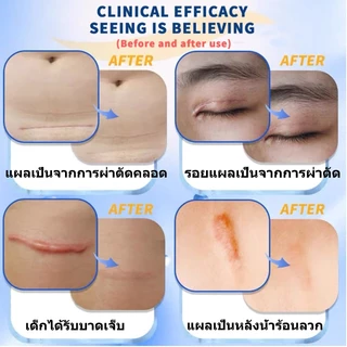 DERMATIX ULTRA (OTC) GEL 15G. เจลป้องกันรอยแผลเป็น