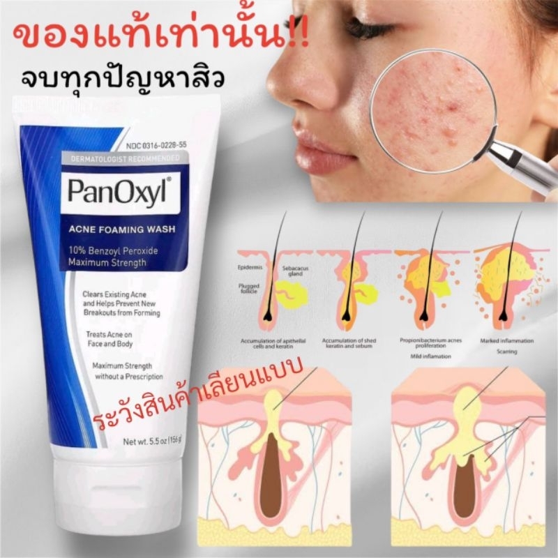 โฟมล้างหน้ารักษาสิว(แพนอ๊อกซิล) PanOxyl, ACNE FOAMING WASH 10% Benzoyl Peroxide Maximum Strength Net wt. 5.5 oz (156g)