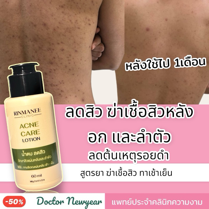 Acne Care น้ำตบ ลดสิว สิวอักเสบ สิวผด สิวยีสต์ ที่หลัง อก และลำตัว สูตรยา สูตรคลินิก