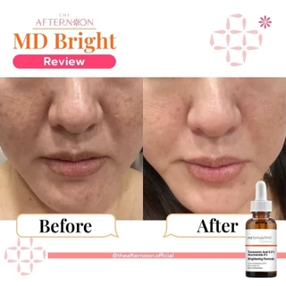 (สินค้าพร้อมส่ง) MD Formula Brightening Serum Tranexamic Acid 2.5%, Niacinamide 4% เซรั่มเปิดกลไกสลายฝ้า กระ