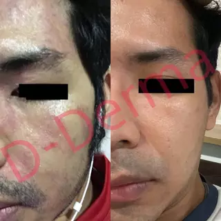 (บริษัท) เซรั่ม Anti-sebderm D-Derma เซ็บเดิร์ม ผิวแห้ง ลอก คัน ผิวหนังอักเสบ แพ้ง่าย ผดผื่น sebderm