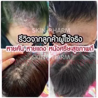 (ร้านเภสัช) เซ็ทแชมพูและเซรั่ม รังแค หนังศีรษะลอก ศีรษะอักเสบ เซ็บเดิร์ม ต่อมไขมันอักเสบ แผลที่ศีรษะ