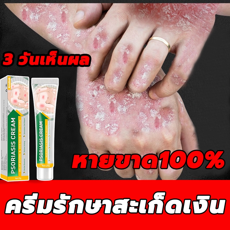 ครีมทาสังคัง สะเก็ดเงินครีม ครีมบำรุงผิว 20g รอยแดง โรคผิวหนัง เกลื้อน กลาก คัน สมุนไพร แก้คันเรื้อรัง คันในร่มผ้า