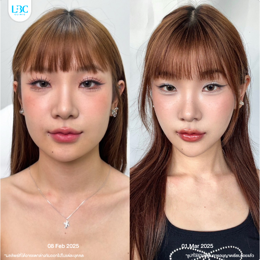 LBC Clinic โปร Size XXL ลดกราม+ลิฟท์หน้า+สลายไขมัน Lipo V 6 เข็ม